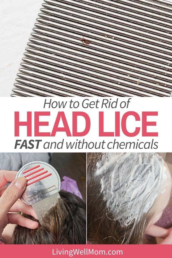 How to Get Rid of Lice Without Chemicals (Natural Lice Treatment)